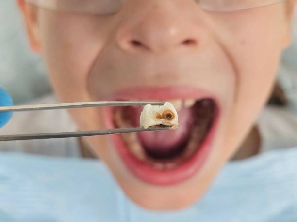 Best Emergency Dental Filling Replacement  in Grambling, LA